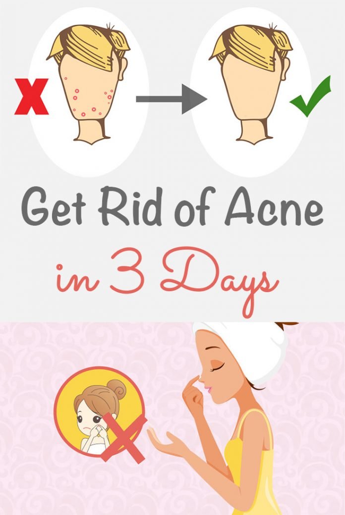 Get Rid Of Acne In 3 Days Iwomenhacks 