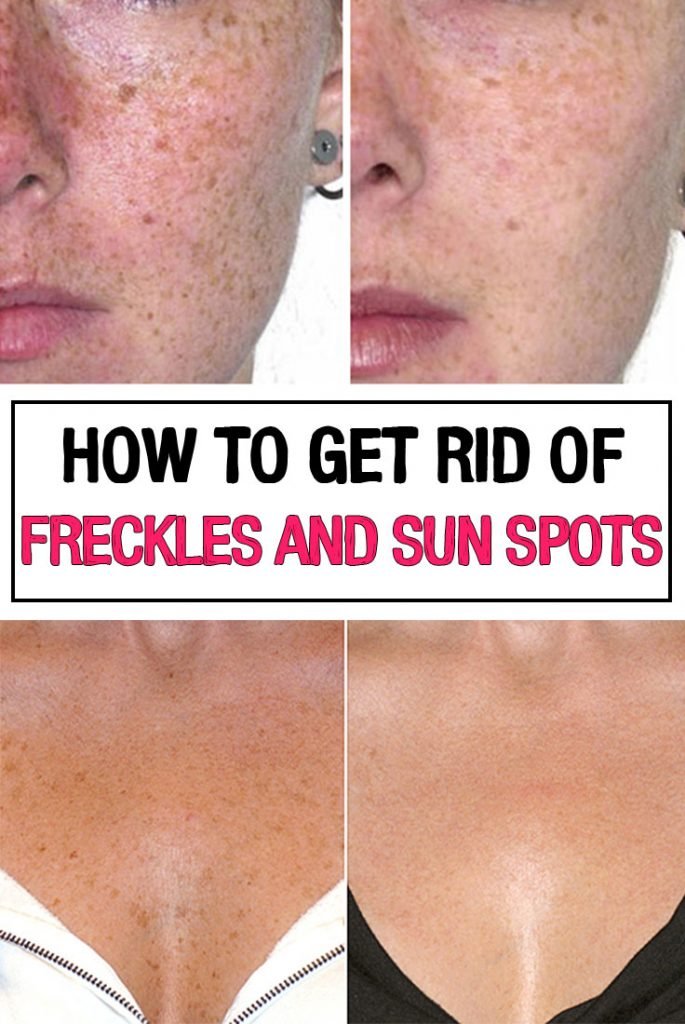 How To Get Rid Of Freckles And Sun Spots Iwomenhacks 9911