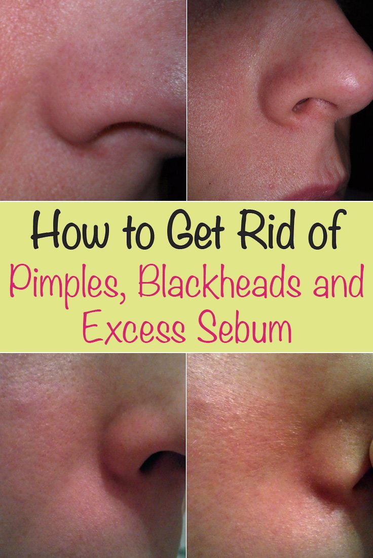 sebum excess rid face blackheads pimples remove
