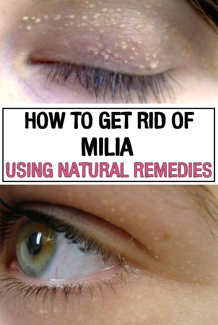 How to Get Rid of Milia Using Natural Remedies