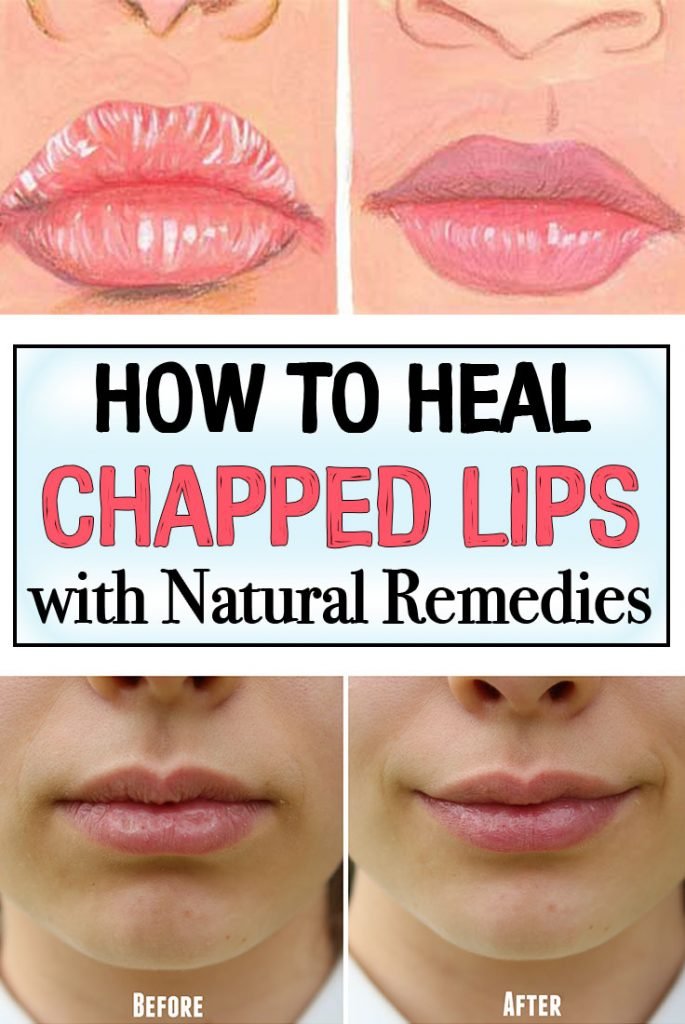 How To Heal Chapped Lips With Natural Remedies Iwomenhacks 9706