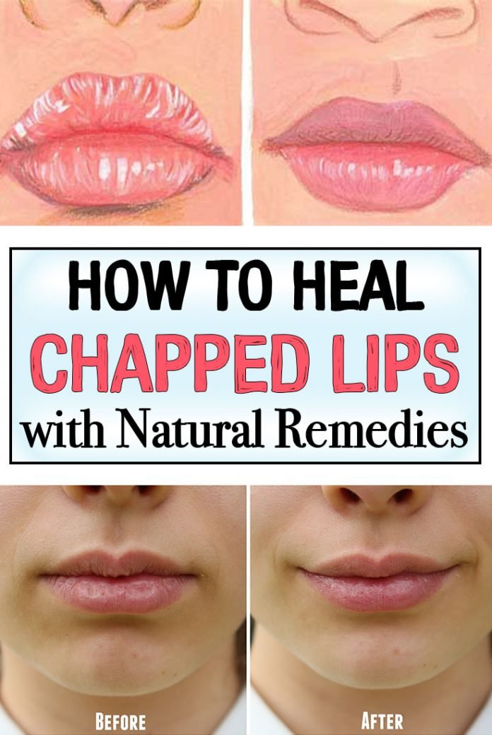 How To Make Chapped Lips Heal Fast