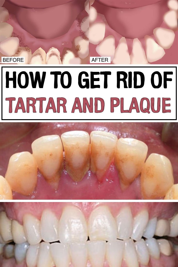 How to get rid of tartar and plaque