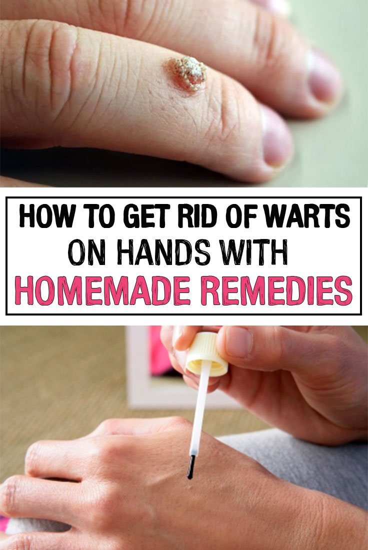 How to Get Rid of Warts on Hands with Homemade Remedies