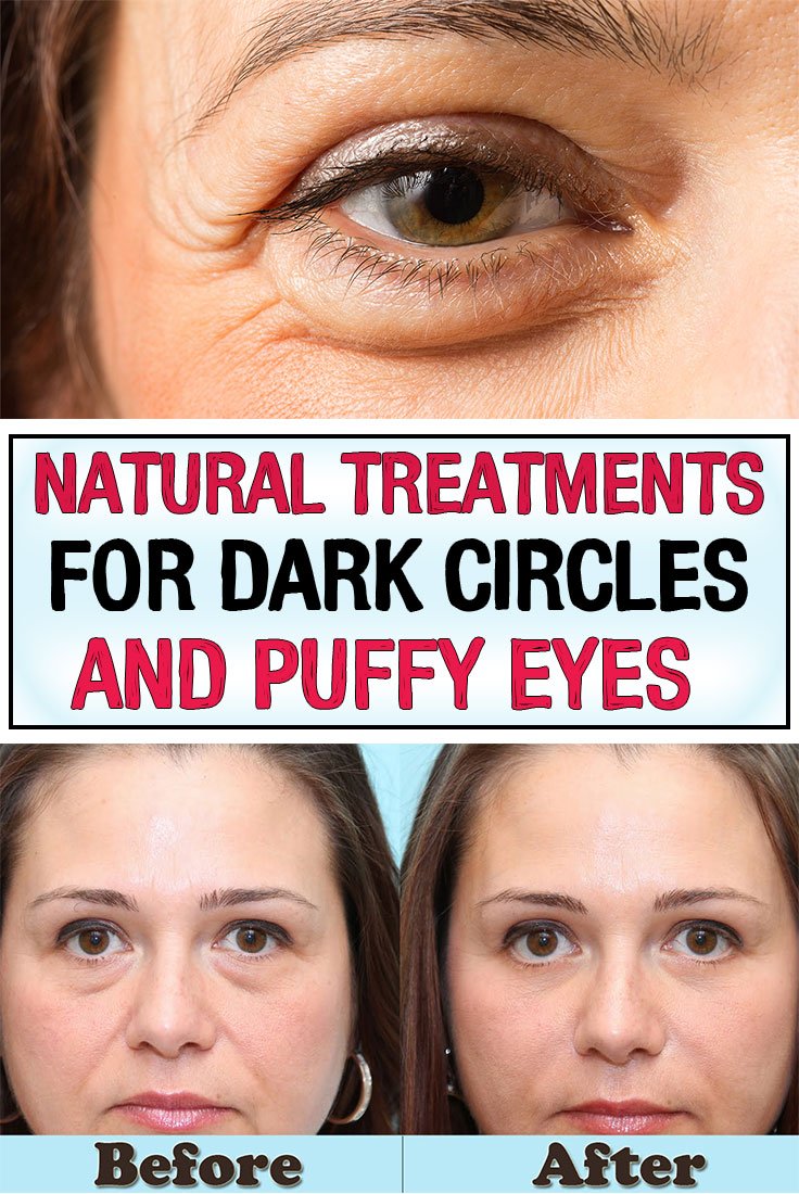 Natural Treatments for Dark Circles and Puffy Eyes