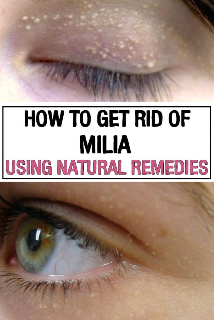 How to Get Rid of Milia Using Natural Remedies - iwomenhacks