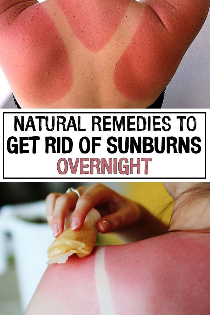 Sunburn Care: What Helps Soothe Skin and When to Seek Help